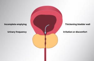 Prostate Artery Embolization Procedure Diagram – Non-Surgical BPH Treatment by Dr. Gaurav Gangwani