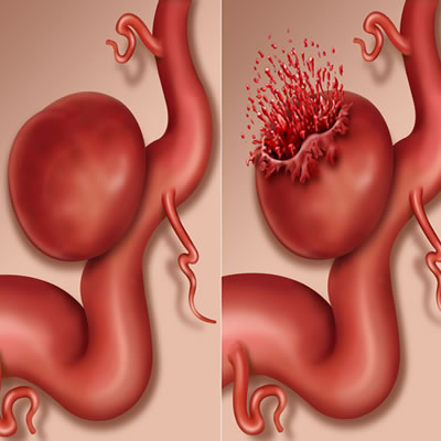Aneurysm Embolization or Coiling