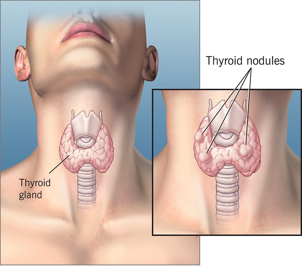 Thyroid Nodule Treatment in Mumbai