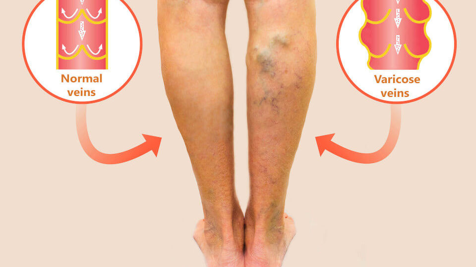Varicose Vein Treatment Dr Gaurav Gangwani