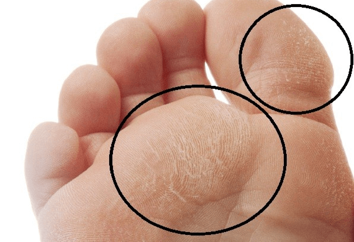 Clinical image showing advanced diabetic foot infection
