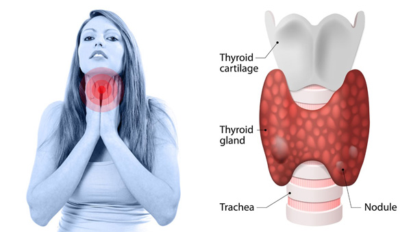 Thyroid Nodule Diagram and Symptoms – Non-Surgical Thyroid Care in India
