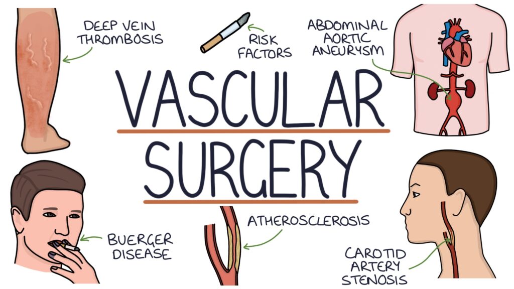 What Does Vascular Surgery Entail? Vascular Surgery in India
