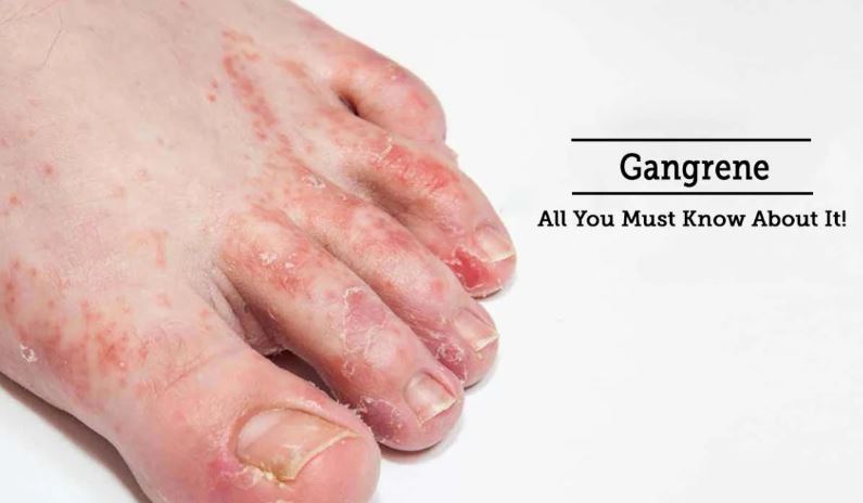 Early Stage Foot Gangrene – Symptoms, Causes, and Treatment Information