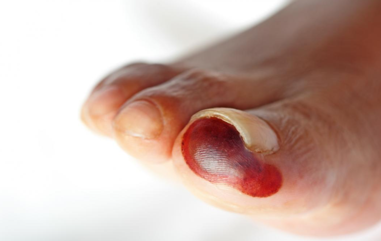 Diabetic Foot Ulcer Treatment with Needle Aspiration – Dr. Gaurav Gangwani"