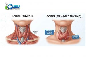 "Thyroid Nodule Treatment in Mumbai – Non-Surgical Care by Dr. Gaurav Gangwani"