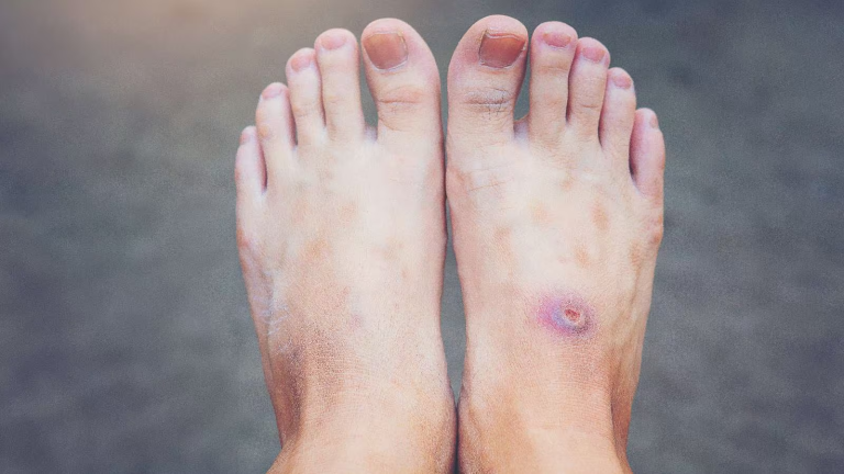Diabetic Foot Ulcer on Right Foot Showing Early Signs of Infection