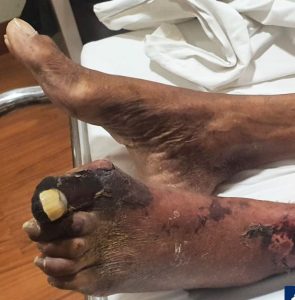 gangrene foot
