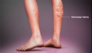 varicose-veins