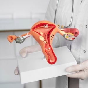 Uterine Fibroids Illustration – Non-Surgical Fibroid Treatment by Dr. Gaurav Gangwani