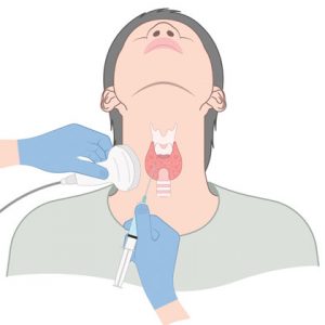 Non-Surgical Solution for Thyroid Nodules – Dr. Gaurav Gangwani, India