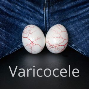 Varicocele Awareness – Minimally Invasive Solution by Dr. Gaurav Gangwani