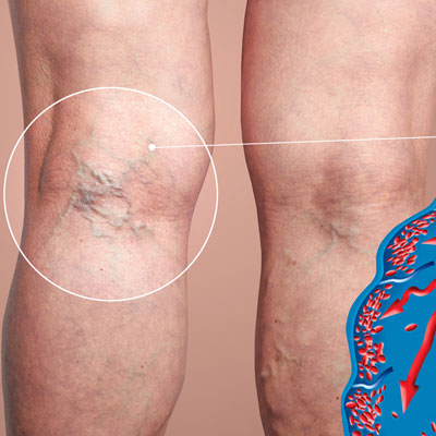Deep Vein Thrombosis Treatment by Dr. Gaurav Gangwani