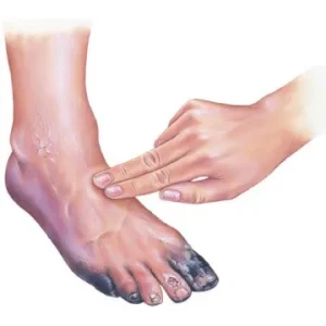 Illustration showing diabetic foot ulcer and management.