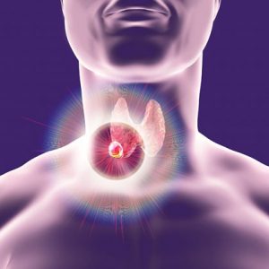 Thyroid Nodule Symptoms