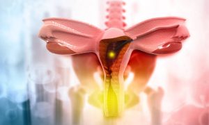 Uterine fibroid embolization showing blocked blood supply.