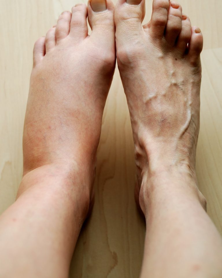 Varicose Veins