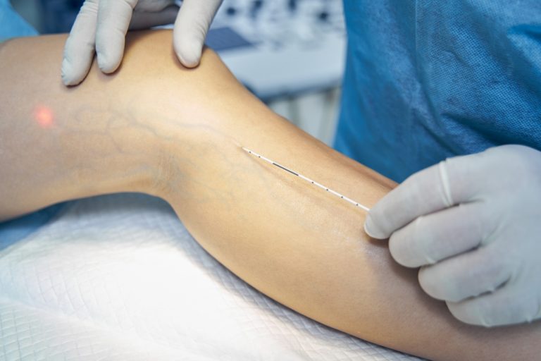 Varicose Veins Diagnosis Explained