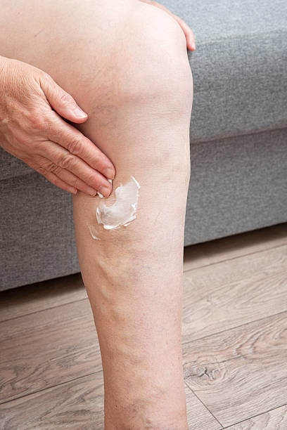Ointment for vericose veins