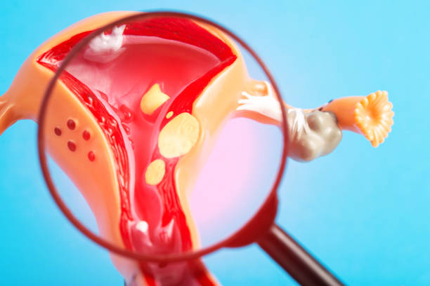 Uterine Fibroids