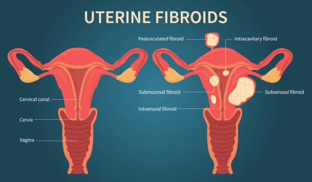 Understand fibroid types