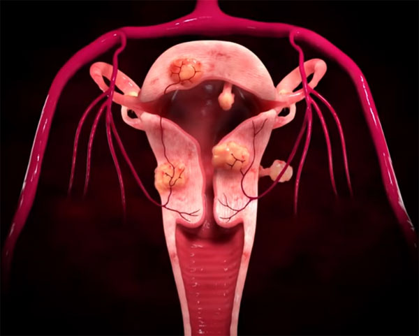 non surgical fibroid-treatment