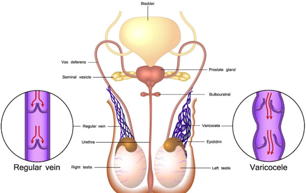 varicocele embolization
