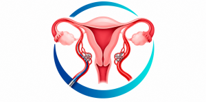 uterine fibroid embolization related image