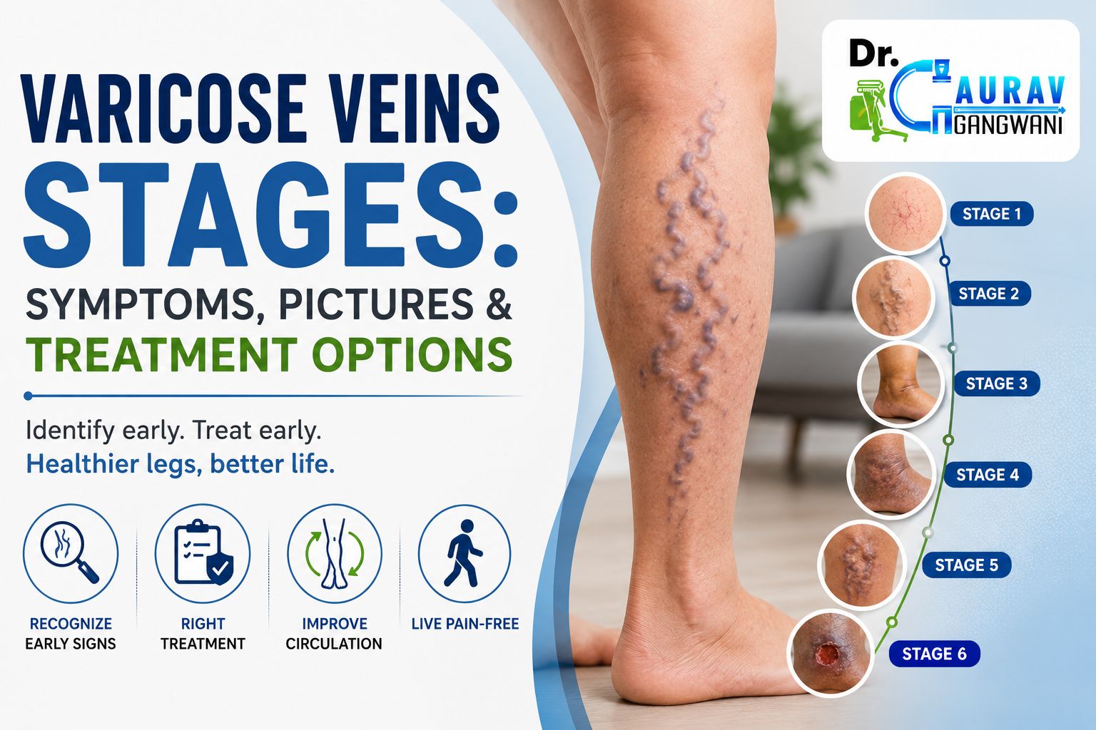 varicose veins stages