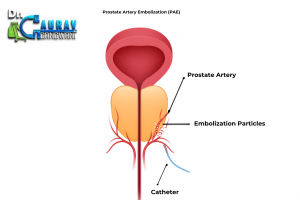 Simple medical diagram showing the bladder, enlarged prostate, urethra, and prostate artery during prostate artery embolization (PAE), with a catheter and embolization particles blocking blood flow to the prostate.