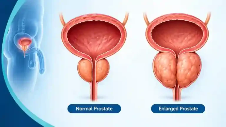 prostate-enlargement-featured-image